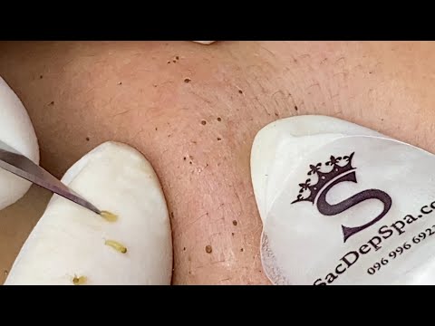 Blackhead On The Skin Of Young Girl | Làm Sạch Mụn Đầu Đen Trên Da Cô Gái Trẻ - SacDepSpa#250