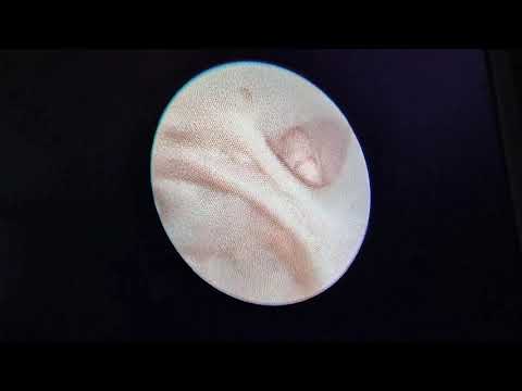 Paediatric Cystoscopy (VUR- secondary)