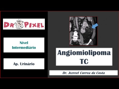 Angiomiolipoma renal