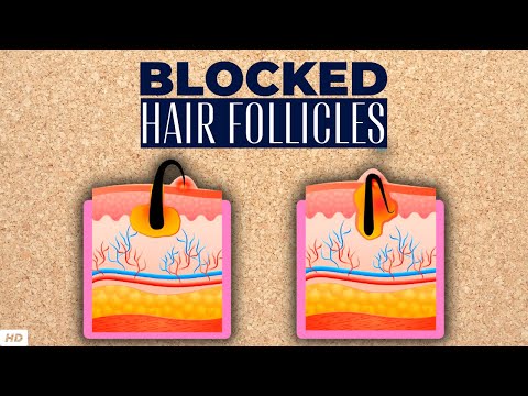 All About Allergy Shots