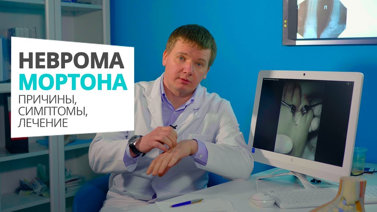 Видео по теме Неврома Мортона