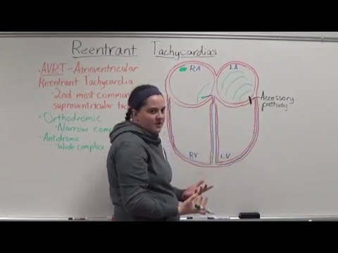 AVRT---Orthodromic and Antidromic