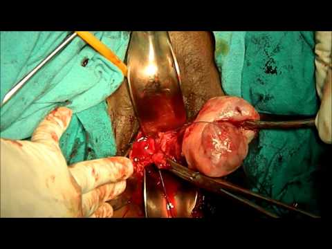 Vaginal Part of Laparoscopic Hysterectomy