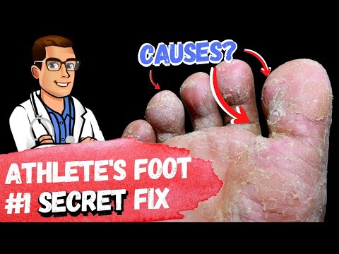 , title : '🦶BEST 9 Athlete's Foot Fungus Remedies [& the #1 Big Mistake]🦶'