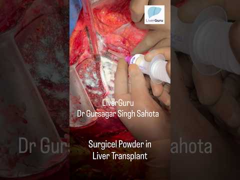 Hemostasis in Living Donor Liver Transplant Recipient | SURGICEL® Powder | Dr Gursagar Singh Sahota