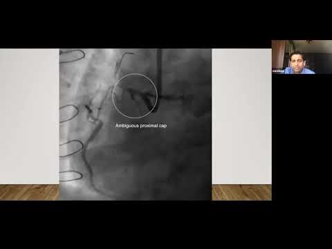 CTO- PCI Best of Both Wordspci by Dr Sandeep Basavarajaiah