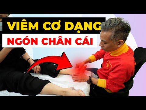 Đau Ngón Chân Cái Không Thể Đi Lại? Cách Chữa Viêm Cơ Dạng Hiệu Quả
