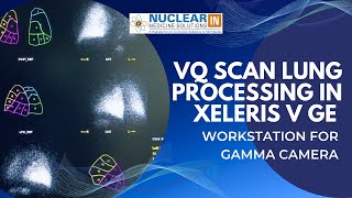 VQ Scan Lung Processing Tutorial | Xeleris V GE Workstation | Nuclear Medicine Workflow Guide