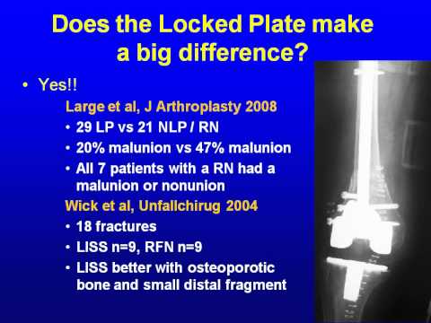Periprosthetic fractures - Diagnostic and current concepts