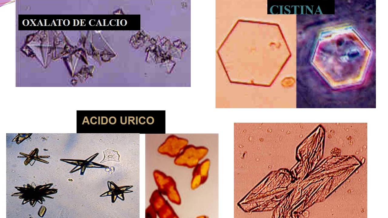 funcion renal proteinuria, hematuria
