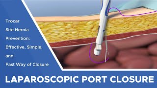 Effective, Simple and Fast Way of Laparoscopic Port Closure for Trocar Site Hernia Prevention