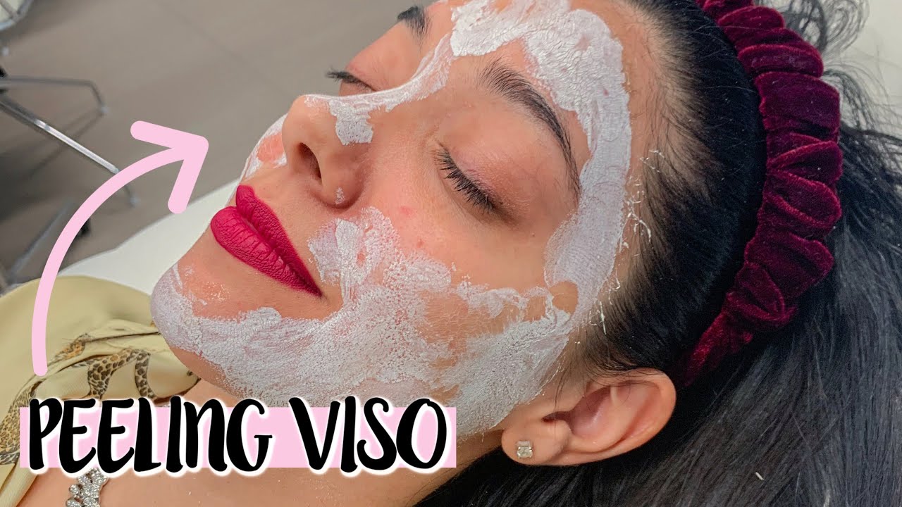 COME TOGLIERE LE MACCHIE POST ACNE - PEELING VISO | Vanessa Ziletti