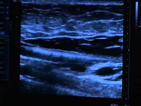 Venefit Procedure by Covidien | VNUS Closure | Vegas Valley Vein