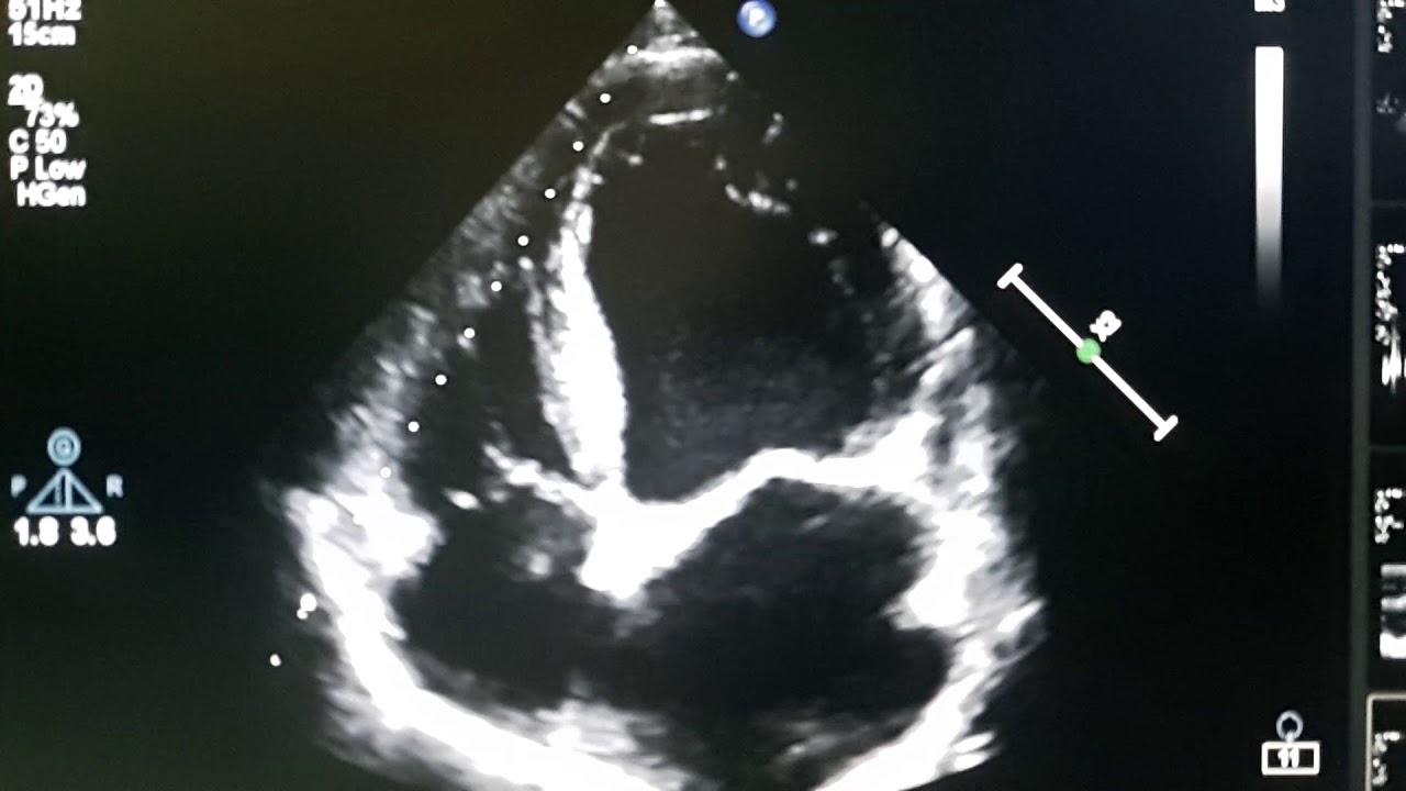 DCMP WITH SEVERE LV SYSTOLIC DYSFUNCTION