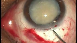 MSICS at Geta Eye Hospital