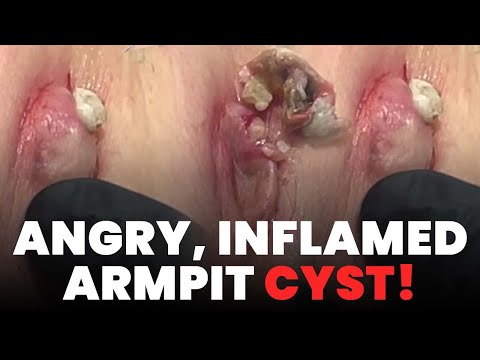 ANGRY, INFLAMED ARMPIT CYST!
