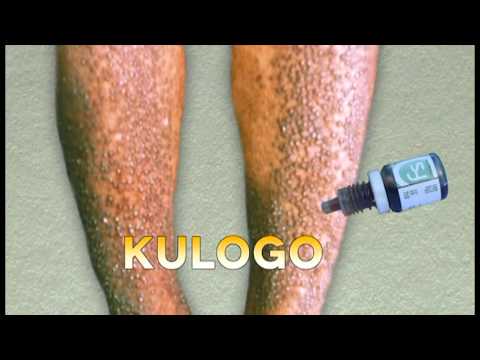 Kuko halamang-singaw sa mga kamay ng mga tinedyer Paggamot ng kuko halamang-singaw sa Kirov