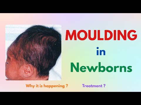 Head Moulding in Newborns Explained | Why Baby’s Head Shape Changes After Birth