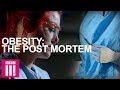 Autopsy On An Obese Woman: Obesity Post-Mortem