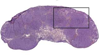 MYO5A-NTRK3 pseudo-schwannomatous Spitz nevus: morphological clues in the #NonAIpath project