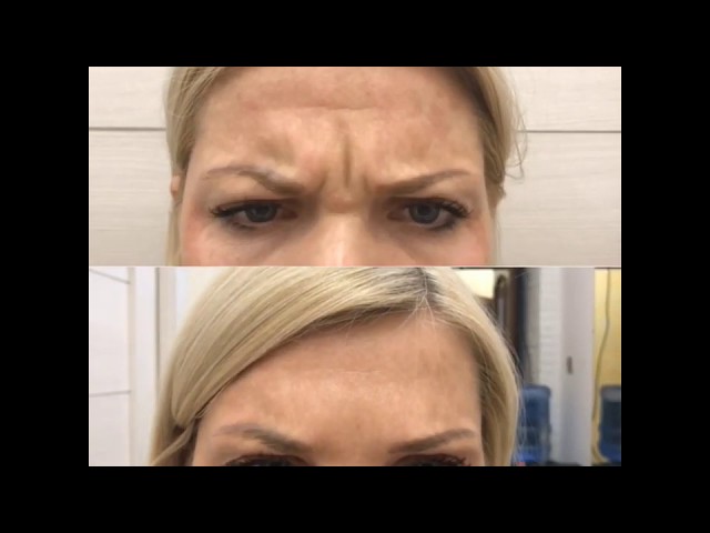 Коррекция морщин ботоксом