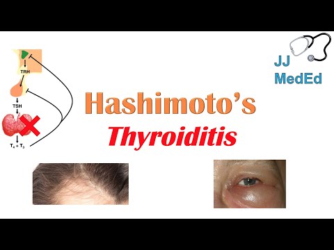 Hashimoto’s thyroiditis: What Is It, Who's At Risk and What You NEED to Know