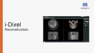 Learn how to utilize Morita's unique Zoom Reconstruction and 180 Degree Reconstruction features to create new volume data without the need to re-scan…