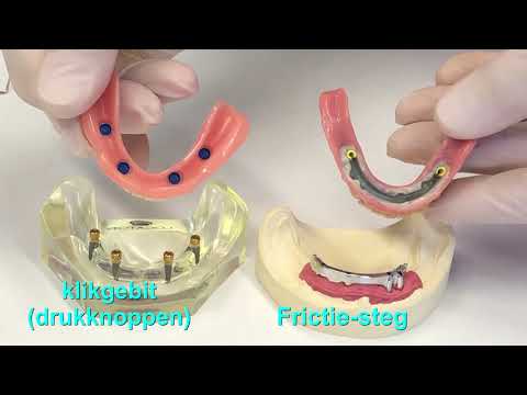 Locator Prothese, Druckknopf, Gaumenfrei Prothese, Implantat Prothese