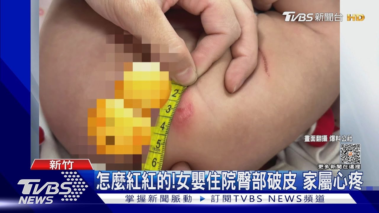 怎麼紅紅的!女嬰住院臀部破皮 家屬心疼