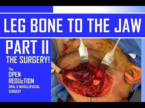 The Surgery | Leg Bone To The Jaw | Part 2 