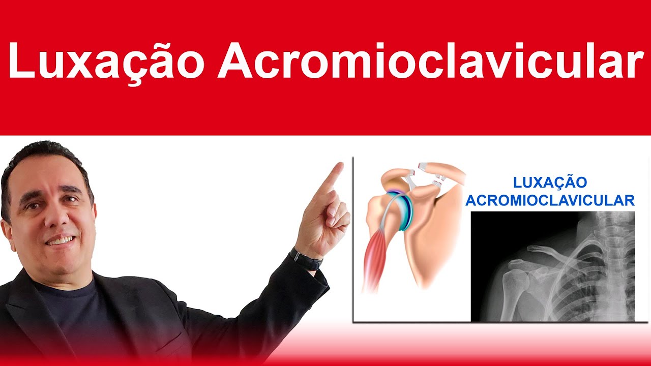Luxação Acromioclavicular