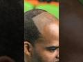 BARBERS STOP PUSHING HAIRLINES BACK 🙅🏽‍♂️💈