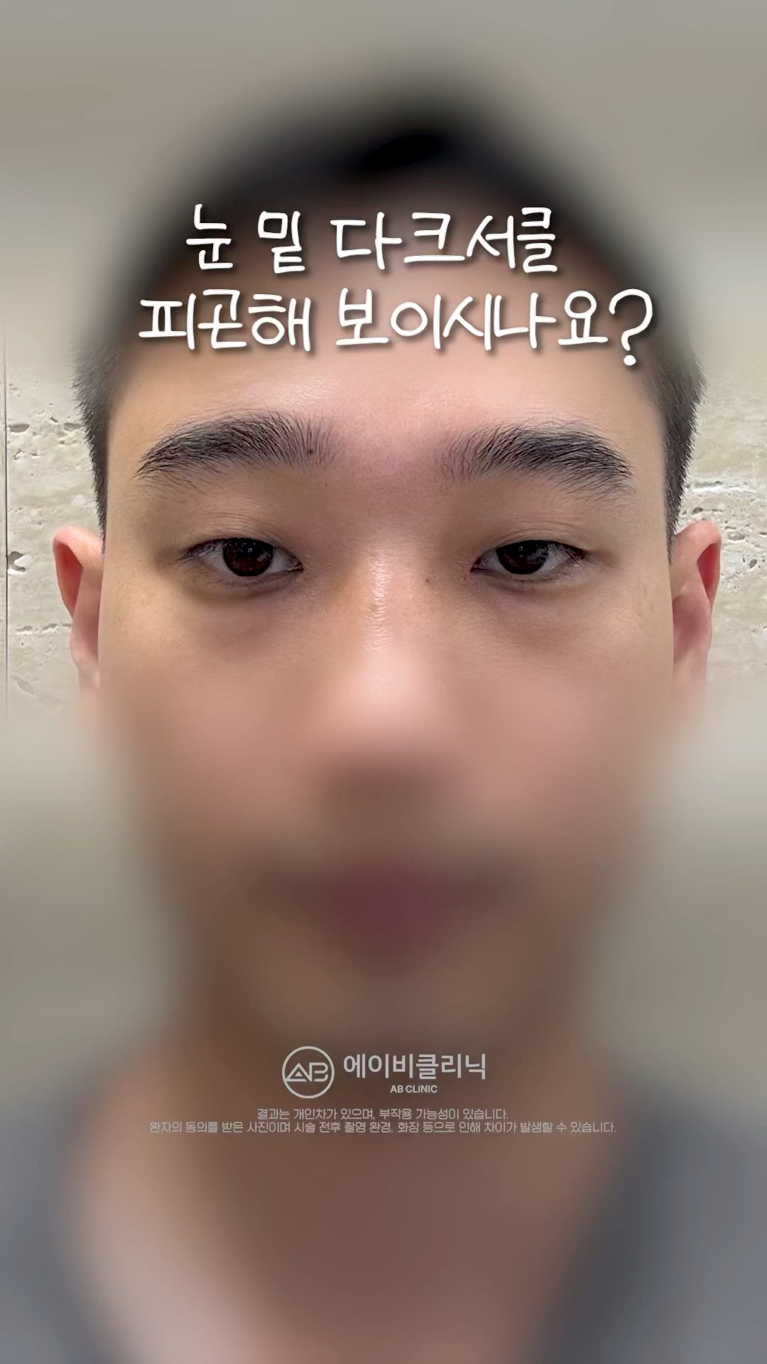 다크서클 지우개 리얼 후기 ✨