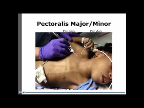 2016 Annual Assembly Preview: Ultrasound, Ultrasound Pediatric Applications in the Upper Limb