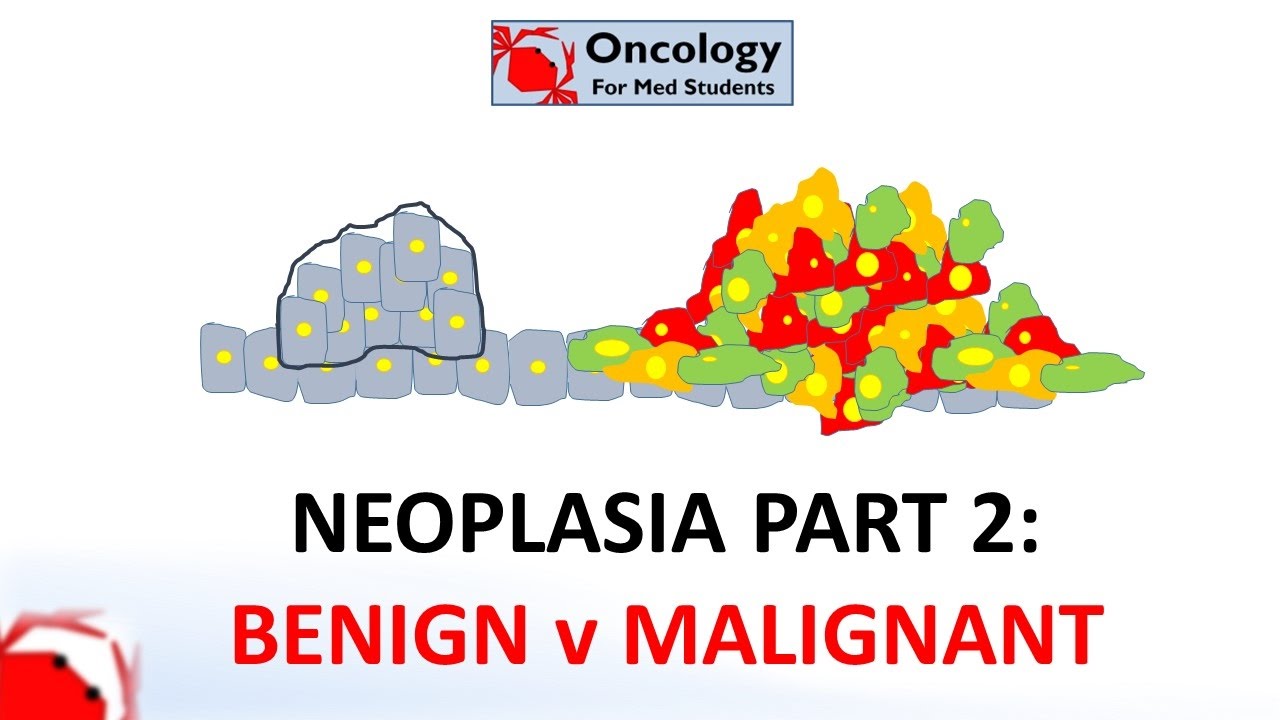 2. Neoplasia part 2: Differences between benign and malignant neoplasms