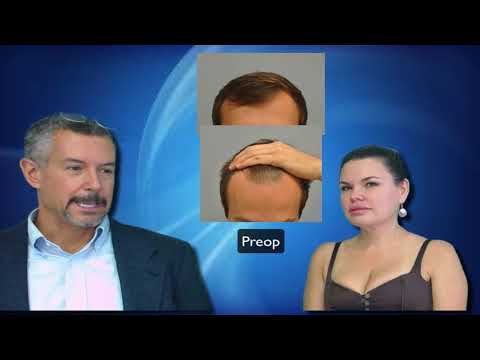 23 year old 14 months out from frontal hair restoration with Dr. Lindsey in DC | McLean | Virginia thumbnail
