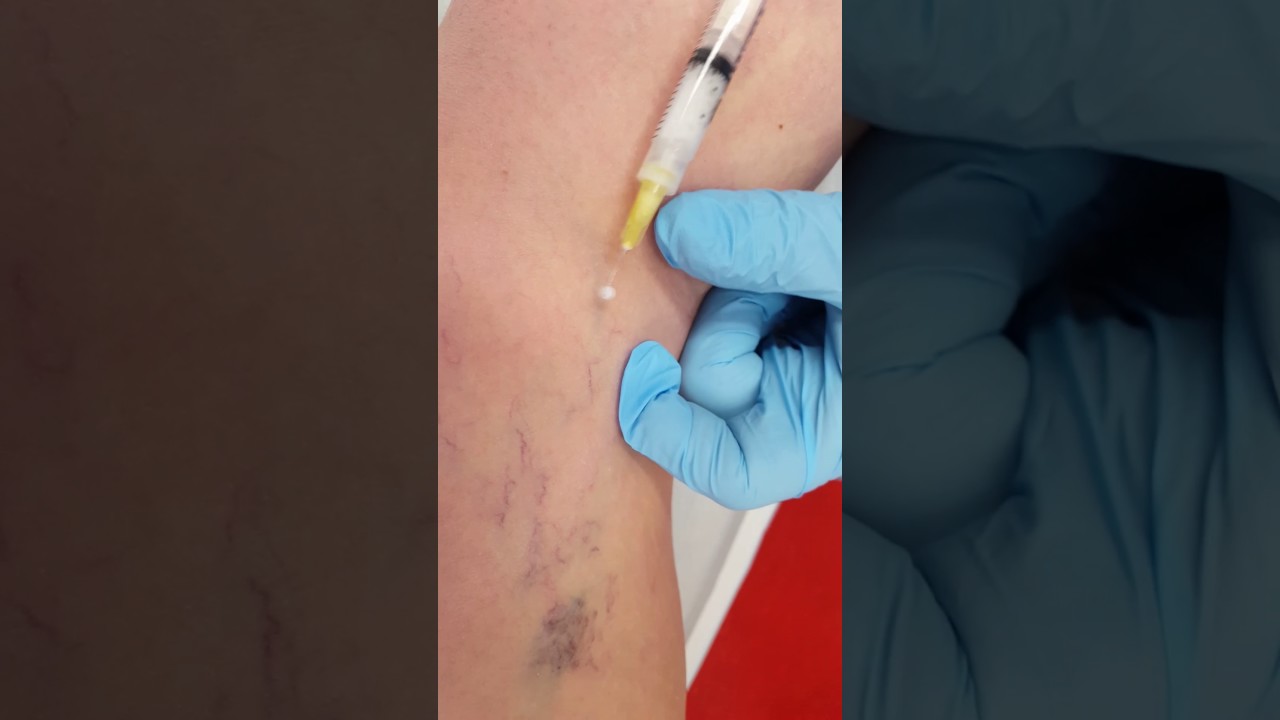 Sclerotherapie varices foam