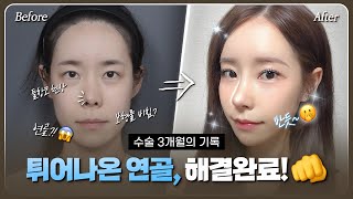 [후기있음] 코 수술 후 튀어나온 연골..! 재수술 결과는!? #코성형 #보형물 #연골