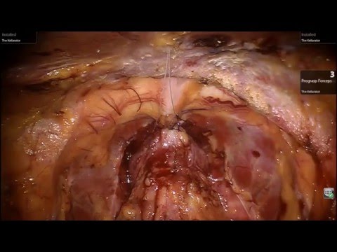 Robotic Prostatectomy