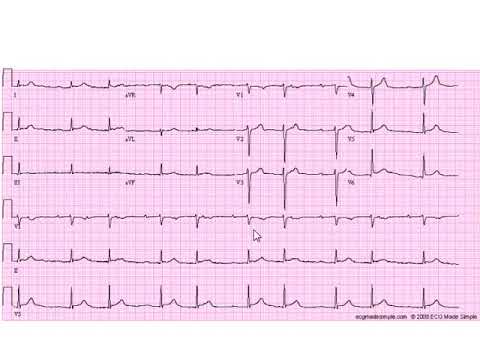 Stepwise Interpretation 9: Second Degree AV Block, Mobitz I (Wenckebach)