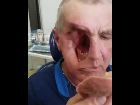 Facial palsy at birth