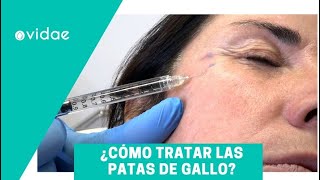 Cómo tratar las patas de gallo