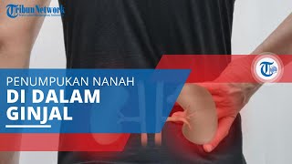 Abses Ginjal, Penyakit yang Ditandai dengan Munculnya Nanah di Dalam Ginjal karena Infeksi Bakteri