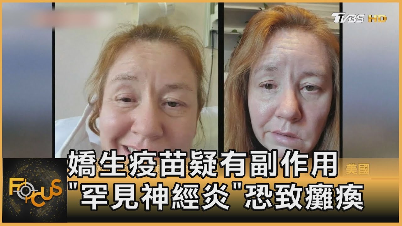 嬌生疫苗副作用「罕見神經炎」恐導致癱瘓