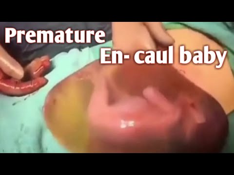 Premature Baby Born Inside The Amniotic Sac 'En-Caul/ IUGR/low Birth weight baby