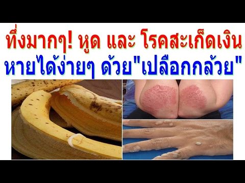 Fenugreek ในโรคสะเก็ดเงิน Suprastinum จาก neurodermatitis