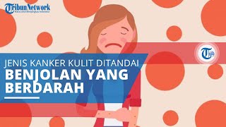 Karsinoma Sel Basal, Jenis Kanker Kulit Ditandai dengan Kemunculan Benjolan yang Mudah Berdarah