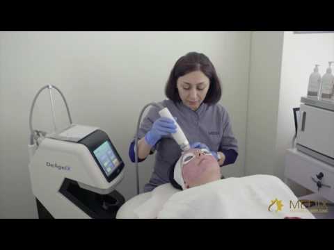 Radio frequency Needling Melbourne