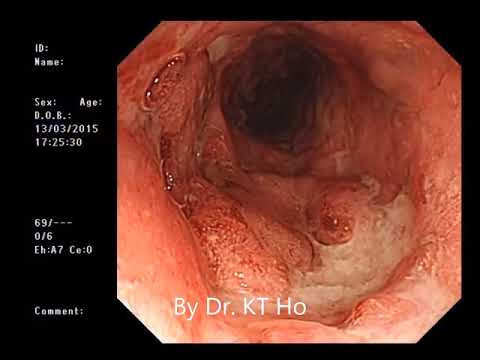 炎症性腸病(IBD) # 潰瘍性結腸炎 (Ulcerative colitis) # Dr. Ho Kai Tin # 何佳鈿醫生