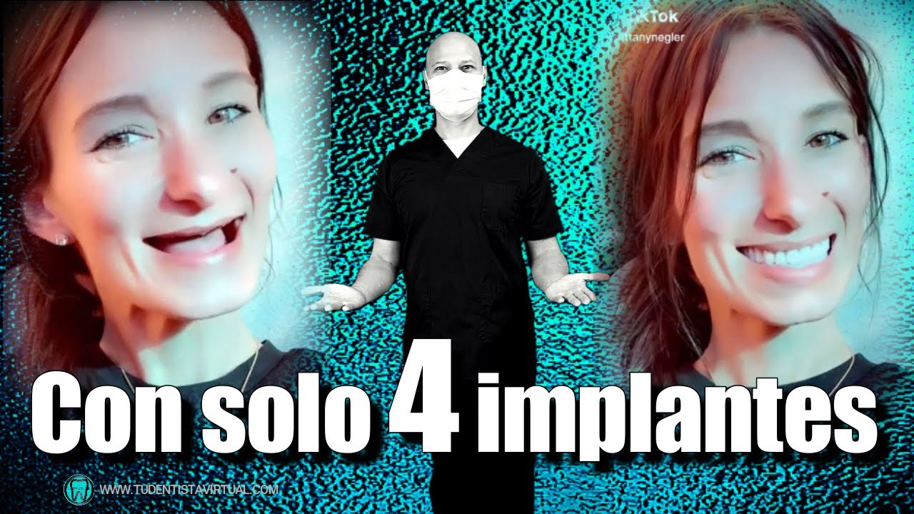 Watch Lo que NO te dicen de las PROTESIS con IMPLANTES Dentales Now Lo que NO te dicen de las PROTESIS con IMPLANTES Dentales